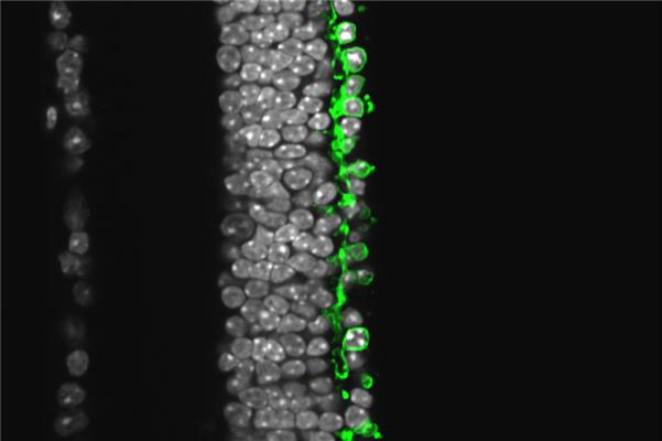 Cross section of a degenerated Retinitis pigmentosa retina